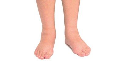 Edema Remedies